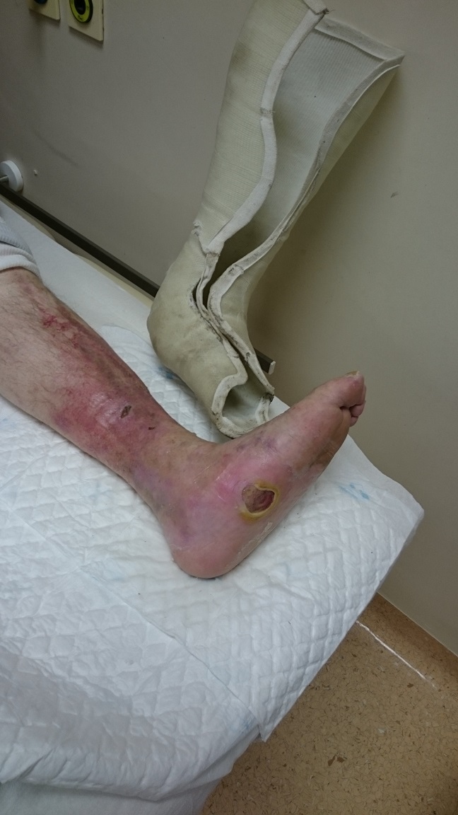 Kronična rana na stopalu brez kroničnega venskega popuščanja